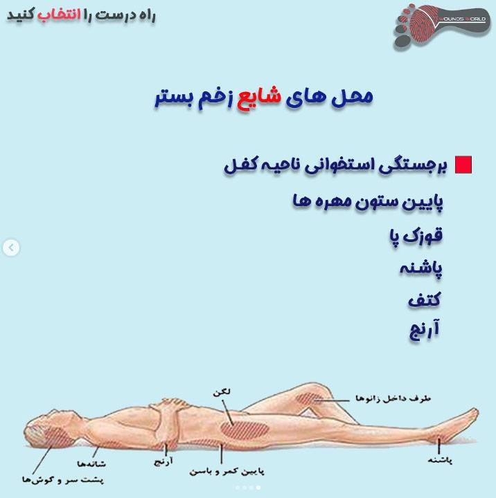 محل های شایع زخم بستر