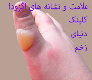 اگزودا