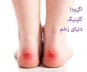 اگزودا