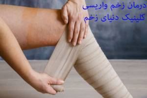 درمان زخم واریسی