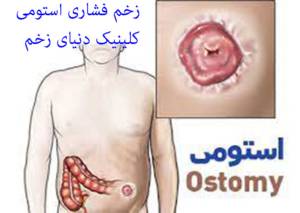 زخم فشاری استوما