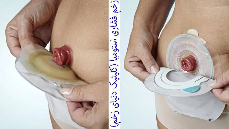 زخم فشاری استوما