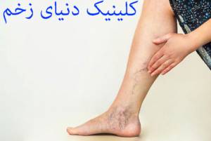 زخم های وریدی
