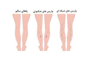 زخم های وریدی