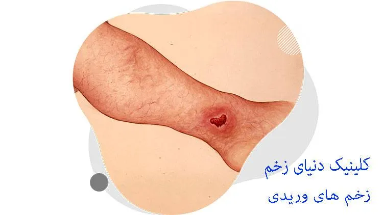 زخم های وریدی