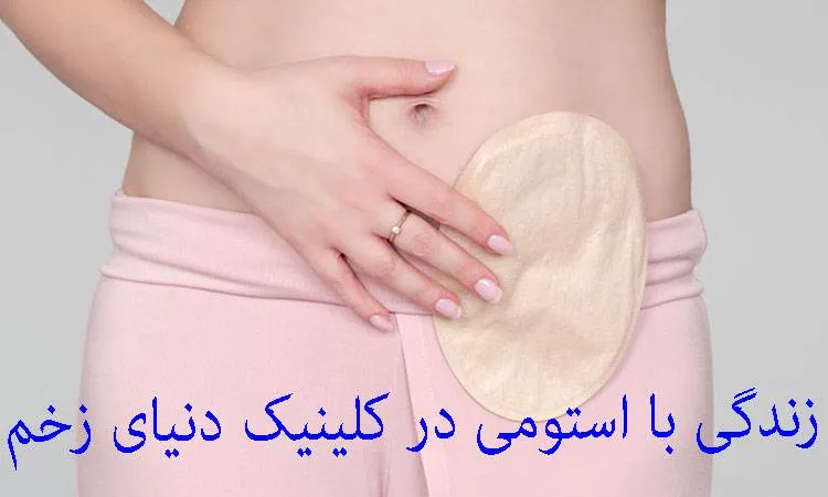 زندگی با استومی