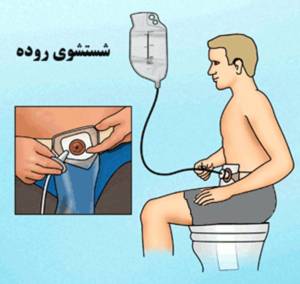 شستشوی روده بزرگ در بیماران کلستومی