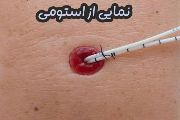 استومی