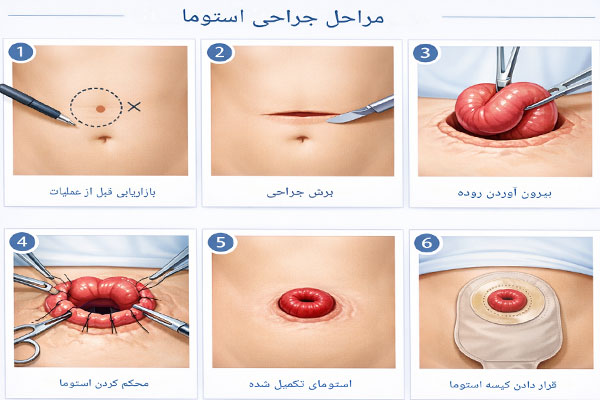 استومی