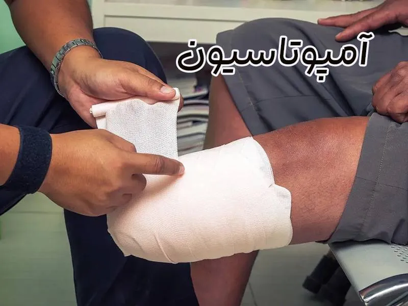 آمپوتاسیون