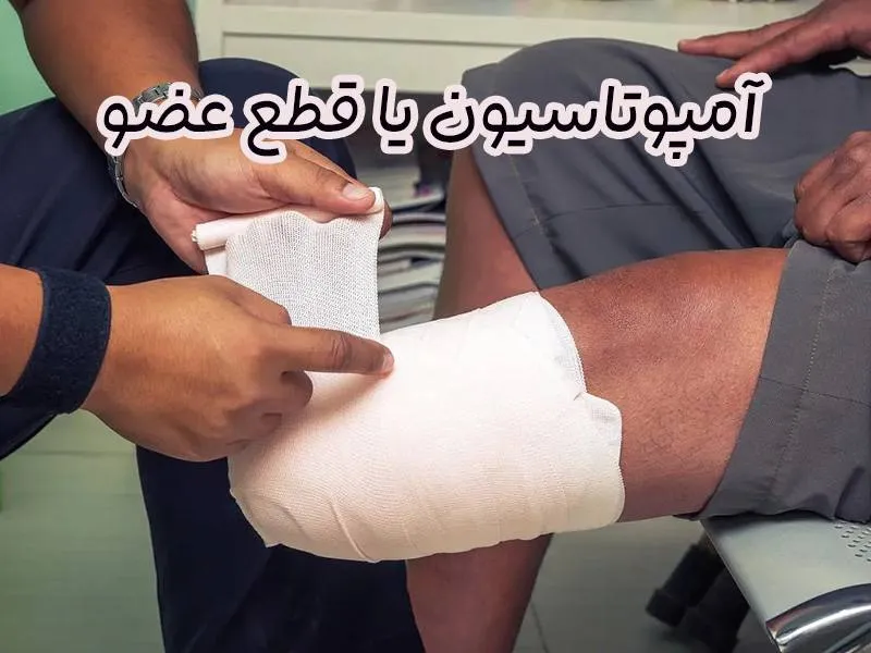 قطع عضو آمپوتاسیون
