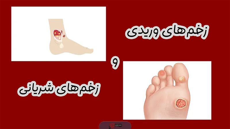 زخم های وریدی و شریانی