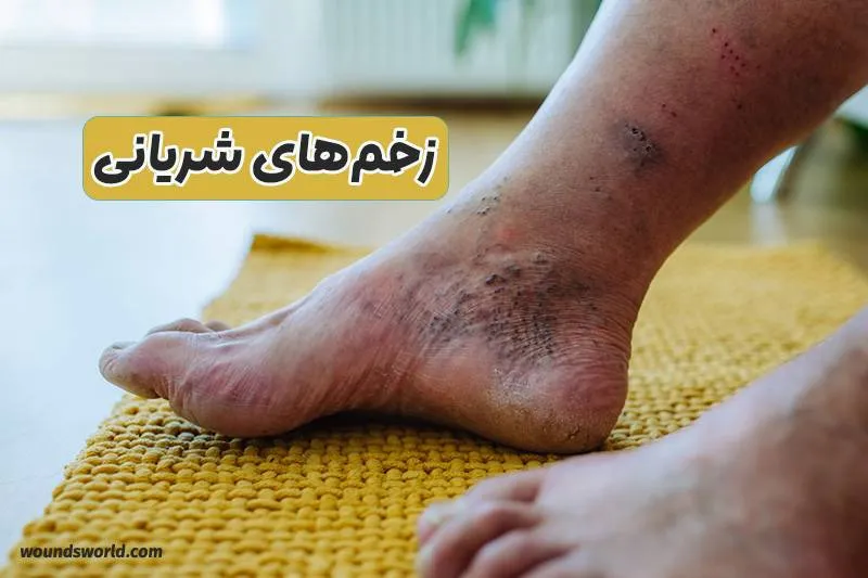 زخم های شریانی