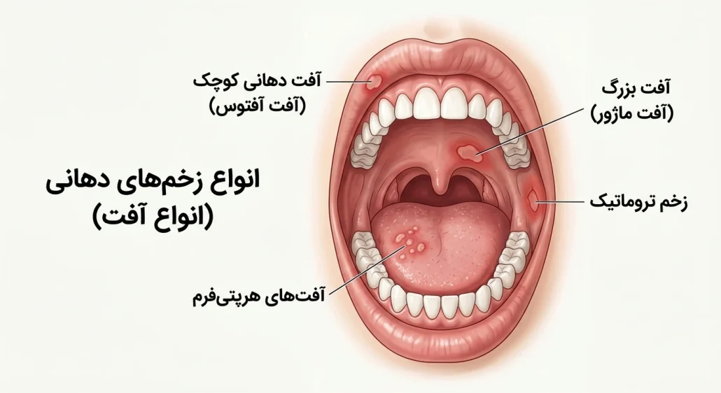 اتواع زخم دهانی