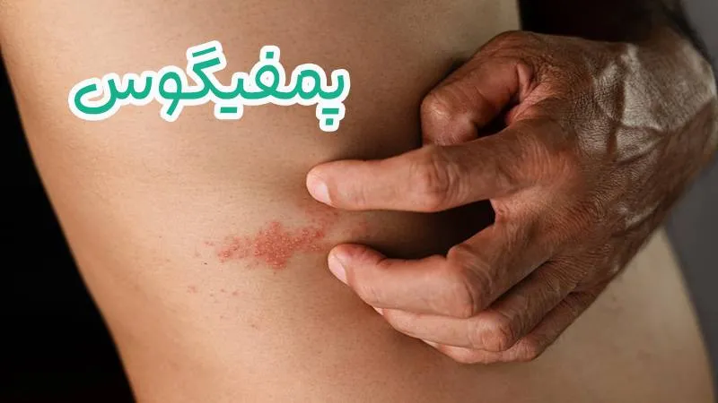 پمفیگوس