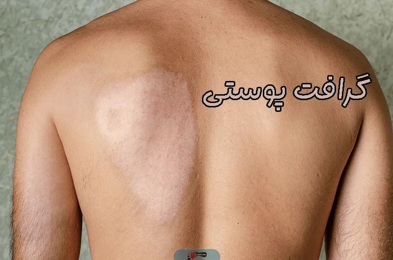 گرافت پوستی