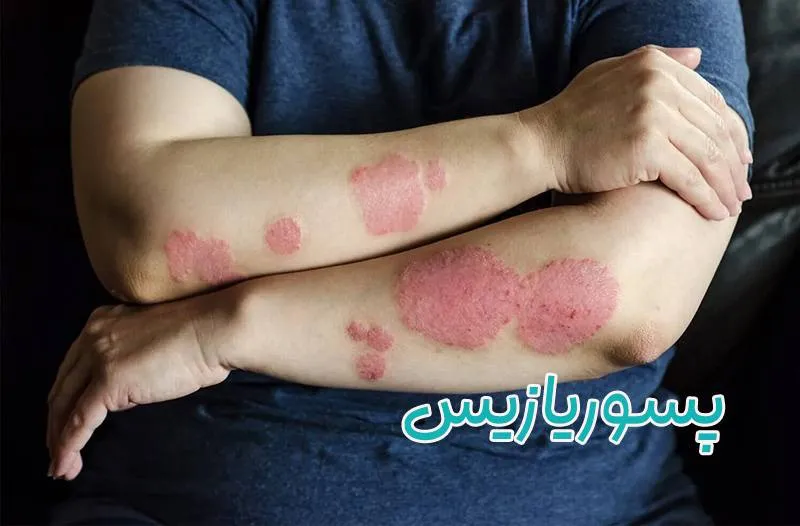 پسوریازیس