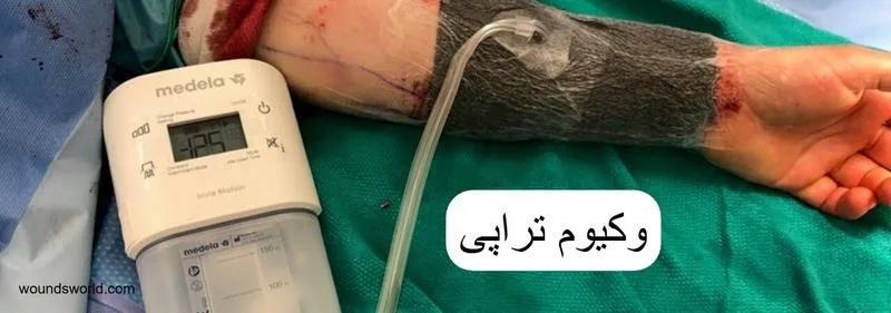 وکیوم تراپی