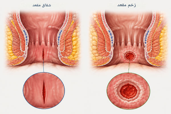 تفاوت مقعدو شقاق
