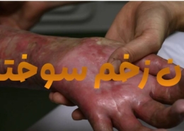 درمان قطعی زخم سوختگی