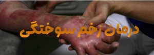درمان قطعی زخم سوختگی
