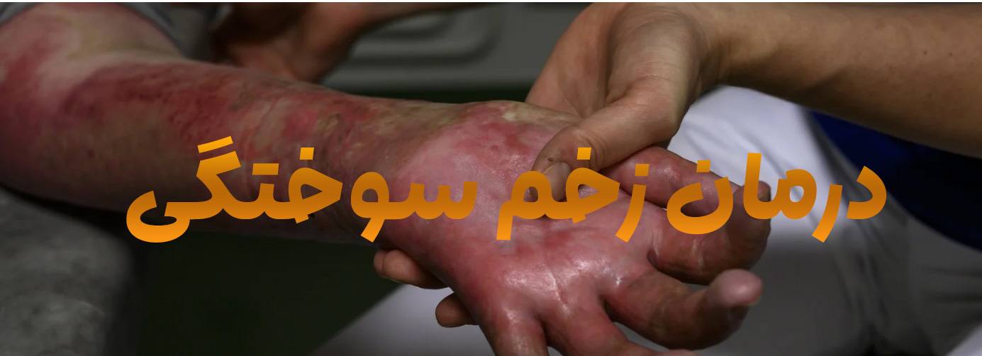 درمان قطعی زخم سوختگی