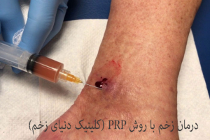 درمان زخم با روش PRP