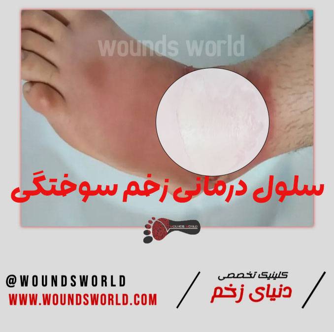 زخم-سوختگی