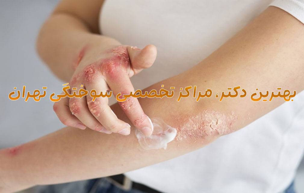 دکتر سوختگی تهران