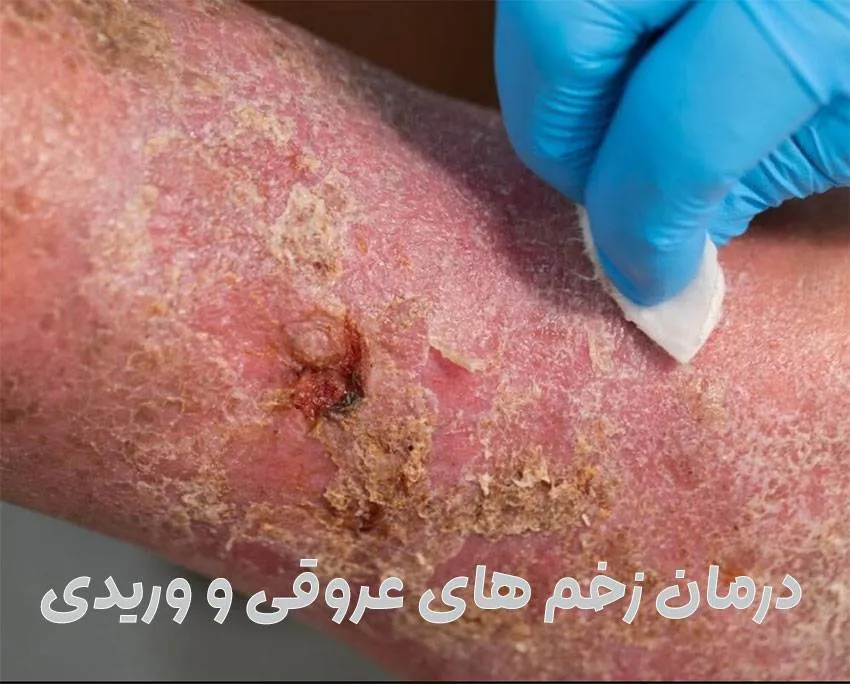 بهترین روش‌های درمان زخم عروقی و شریانی