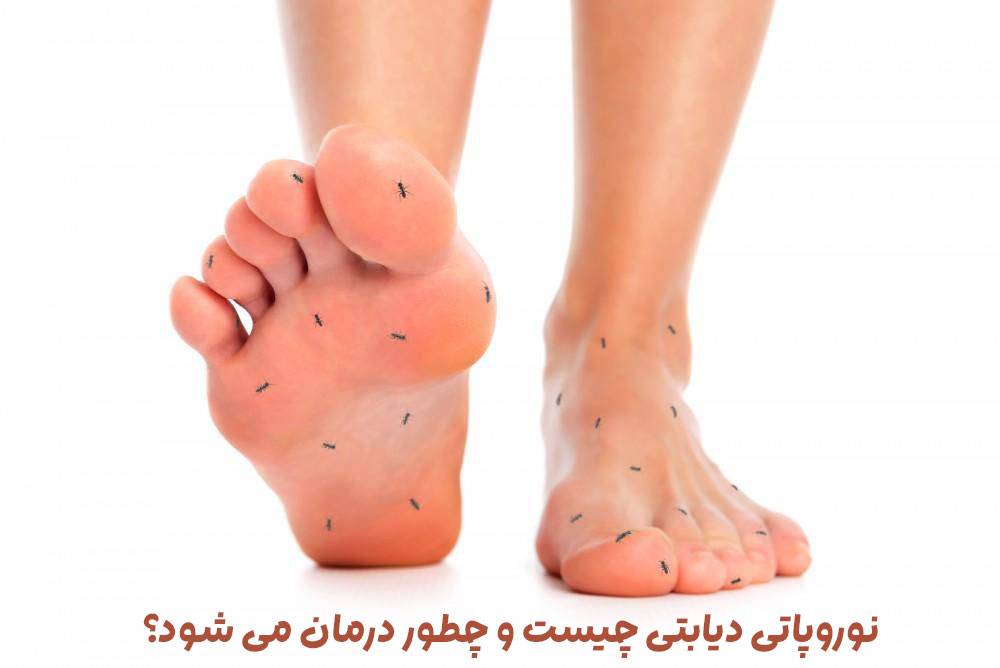 نوروپاتی دیابتی