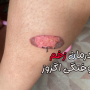 درمان زخم سوختگی اگزوز