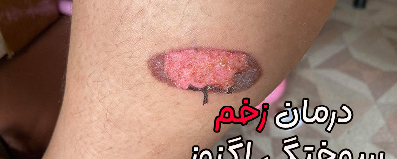 درمان زخم سوختگی اگزوز