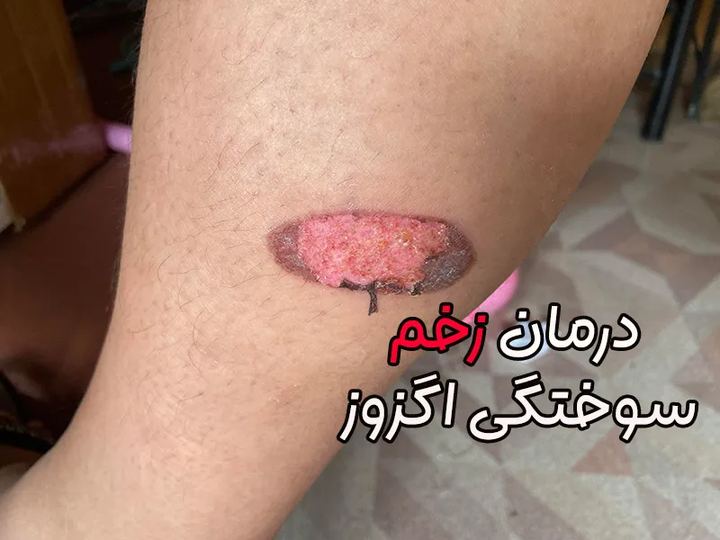درمان زخم سوختگی اگزوز