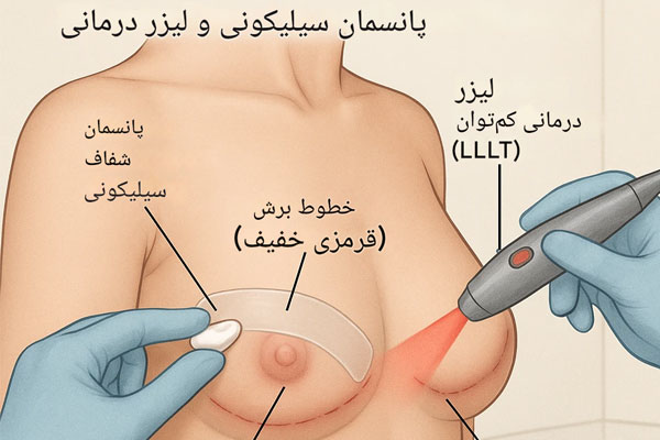 درمان زخم ماموپلاستی