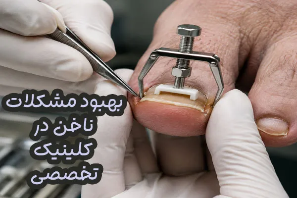 درمان بیماری ناخن تهران