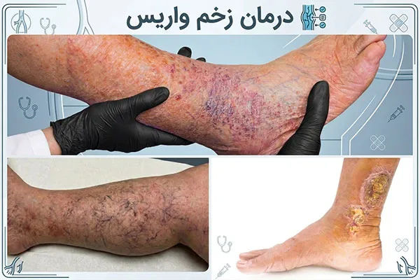درمان-زخم-واریسی