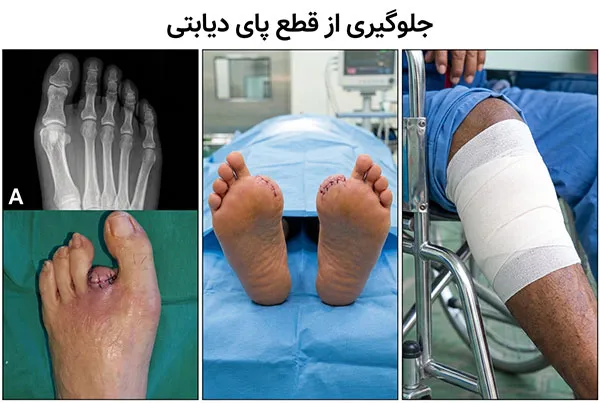 قطع-پای-دیابتی