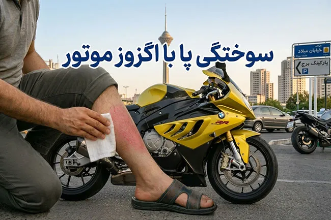 درمان سوختگی پا با اگزوز موتور