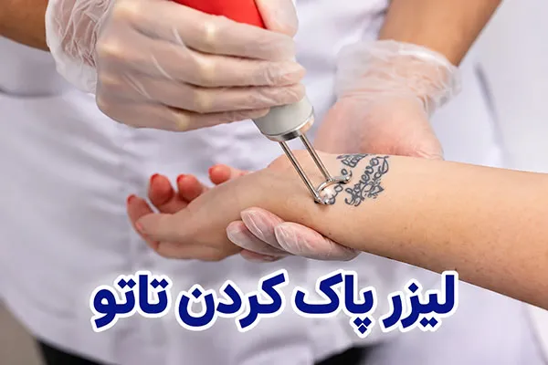 لیزر-پاک-کردن-تاتو